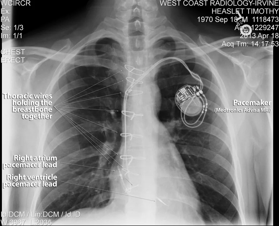 Annotated chest X-ray showing the hardware left behind