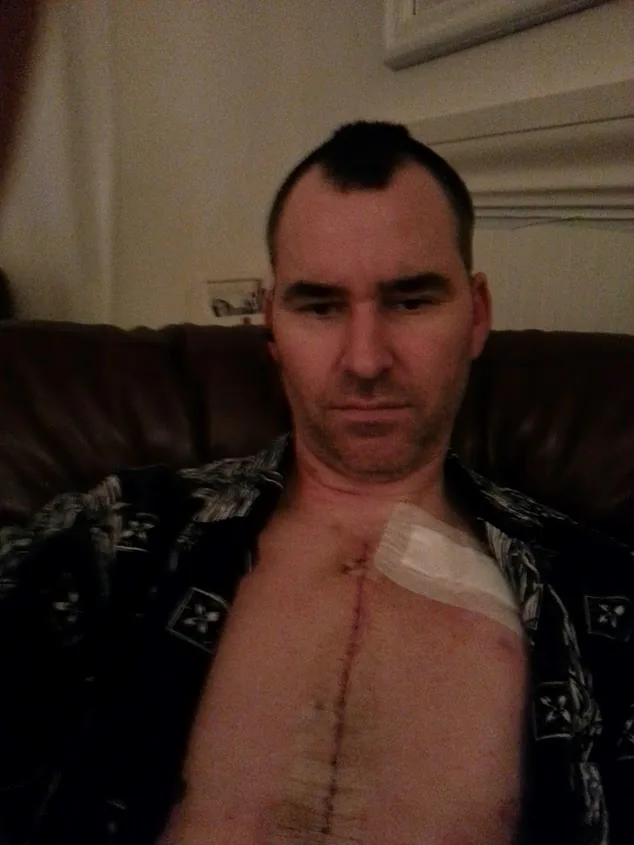 The sternum scar, photographed at home during recovery