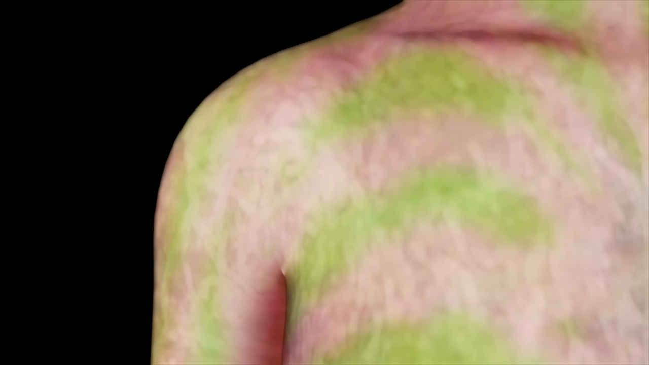 [03:23] A 3D CGI render of a woman's chest and shoulders covered in a marbled pattern of green and purple patches, demonstrating the physical map of X-inactivation.